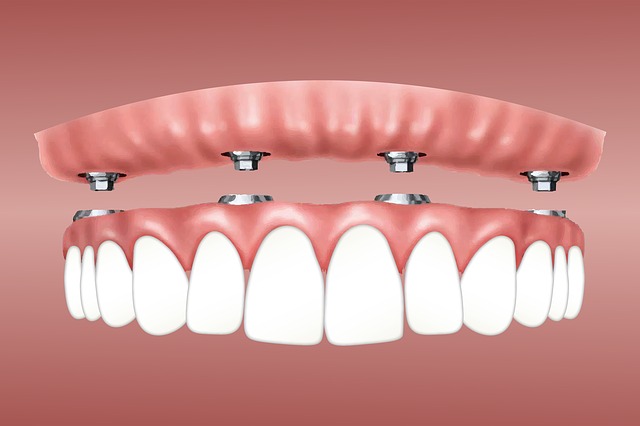 Illustration of a snap on overdenture